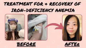 Iron Deficiency Anemia Treatment: My Recovery Story. - Youtube