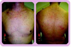 Image result for Fosamprenavir