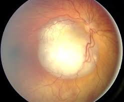 Microphthalmos, iris atrophy, and synechiae are often noted as well. Norrie S Disease