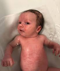 Baby health beauty holiday shop home buy online & pick up in stores all delivery options same day delivery include out of stock baby bath wash baby eczema. Mum Whose Baby Was Covered In Acne Claims 7 99 Coconut Oil Cured The Condition In 24 Hours