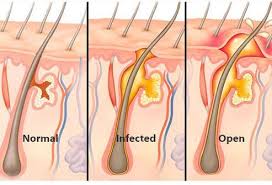 A range of shaving products are available for. How To Get Rid Of Ingrown Hair Removal Tips Remedies