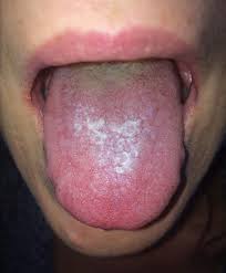 Image result for lichen planus on tongue)
