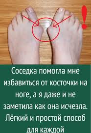 как избавиться от косточки на ноге в домашних условиях Sosedka Pomogla Mne Izbavitsya Ot Kostochki Na Noge A Ya Dazhe I Ne Zametila Kak Ona Ischezla Lyogkij V 2020 G Pohudenie V Talii 1000 Lajfhakov Zhurnal O Zdorove