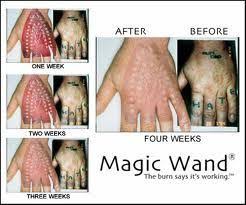 About 45 million americans have at least one. Can You Get Rid Of Tattoos