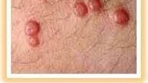 Image result for genital warts