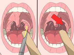 How to remove tonsil stones with finger. 4 Ways To Remove Tonsil Stones Tonsilloliths Wikihow