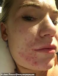 Model clears up her horrific acne with diet and meditation
