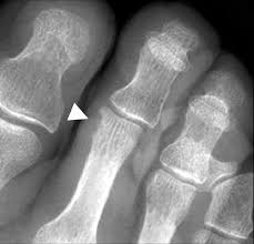Image result for Osteomyelitis XRay