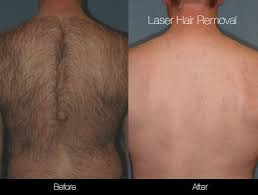 Mens laser hair removal at parramatta westfield. Lightsheer Diode Laser Hair Removal In Toronto Spamedica