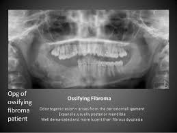 Image Result For Fibrous Dysplasia Ensinar