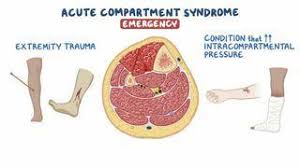 Image result for Compartment Syndrome