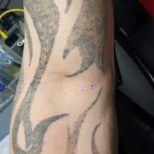 The laser tattoo removal is very painful method. Razalight Tribal Sleeve After 2 Sessions Scaring At