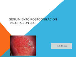 Colposcopia normal, legrado endocervical negativo. Legrado Endocervical Ejercicios De Filosofia Docsity