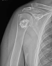 Image result for Chondrosarcoma