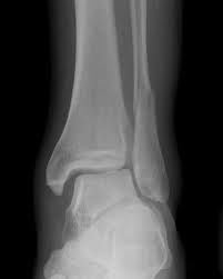 Here's what you need to this can cause permanent damage. Ankle Fracture Wikidoc