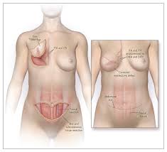 Post-Cancer Reconstruction