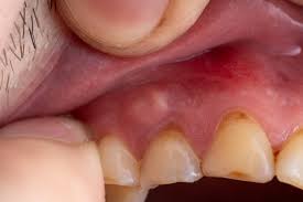 Image result for granuloma gum disease