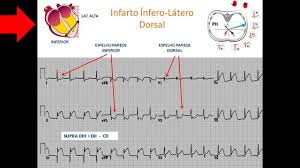 Umdns 16231 electrocardiographs, multichannel, interpretive 18330 electrocardiographs other common names: Dicas De Ecg Imagem Em Espelho Youtube