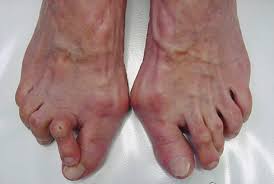 Image result for Hallux Varus