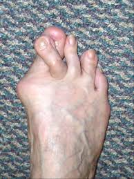 Bob baravarian discusses the different types of bunion surgeries including the lapidus bunionectomy and how to chose a bunion surgeon. Bunion Surgery Podiatrist In Marietta Ga