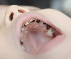 If the bacterial infection grows, it can move to the root of the tooth and attack the jaw and other bone parts. What Do You Do For A Baby With Cavities Angela Evanson Dds In Parker Co Dentist 720 409 0008 80134