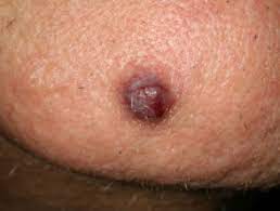 Cherry angiomas are sometimes referred to as senile angiomas, or campbell de morgan spots, and they are very much related to aging. Cherry Angioma Dermnet Nz