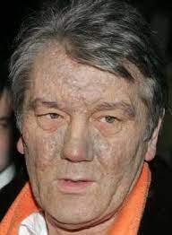 Dioxins are found throughout the world in the environment and they accumulate in the food chain, mainly in the fatty tissue of animals. Doctor Yushchenko Poisoned With Dioxin
