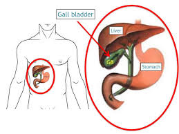 However, when a gallstone obstructs the bile duct and. Gallbladder Stones Treatment Clinic Laparoscopic Gallbladder Surgery Laparoscopic Cholecystectomy Surgeon Surgery