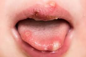 Image result for Puchýře na jazyku