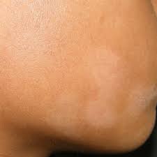 The exact cause is unknown. Pityriasis Alba Symptoms Causes Diagnosis And Treatment