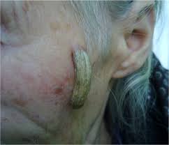 Image result for cornu cutaneum)