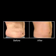 Most medpsas and providers offer gift cards for their services in body contouring and we at element ask about loyalty programs, discounts and rebates, and don't forget to download brilliant distinctions. Coolsculpting Consultation Med Spa And Laser Center Ochs Dermatology San Antonio Tx