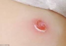 Chiggers often bite the ankles, wrists, thighs, groin, and waist. Dover Girl Hospitalised And Unable To Walk After False Widow Spider Bite Daily Mail Online