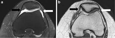 Mri show obliq tear body and posterior horn lateral meniscus, extending infr artic surface and ulceration articular cartilage patella. High Resolution Magnetic Resonance Imaging Of The Patellar Retinaculum Normal Anatomy Common Injury Patterns And Pathologies Springerlink