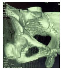Iud intrauterine device removal procedure note. Laparoscopic Removal Of A Migrated Intra Uterine Device Embedded In The Anterior Abdominal Wall In Yaounde Cameroon A Third World Country