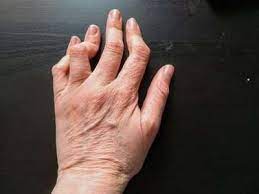 Arthritis Ursachen Symptome Und Behandlung Gelenk Klinik De