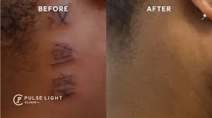 At california skin & laser center, we use a highly sophisticated laser tattoo removal method that yields excellent results. Tattoo Removal For Darker Skin London Pulse Light Clinic London