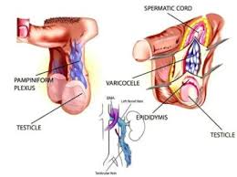 Image result for Varicocele