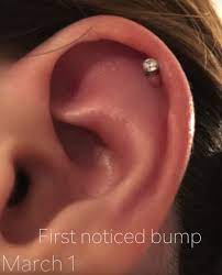 Piercing Bump 6 Ways To Get Rid Of Cartilage Or Nose Keloid Blister