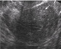 The displaced glands cause spiral. Adenomyosis Glowm