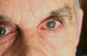 All About Cataract Surgery
