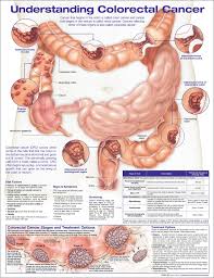 Image result for Colorectal Cancer