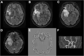 Gray matter is predominantly affected (cognitive / psychiatric signs, lethargy, seizure). Decompressive Craniectomy For Herpes Simplex Encephalitis Complicated By Frank Intracerebral Hemorrhage A Case Report And Review Of The Literature Bmc Neurology Full Text