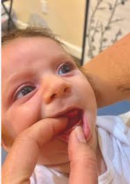 Does posterior ankyloglossia exist as an anatomical entity?