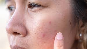 Image result for acne face