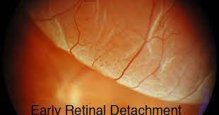Fundus Image Of A Retinal Detachment Eye Exercises Food For Eyes Vision Eye