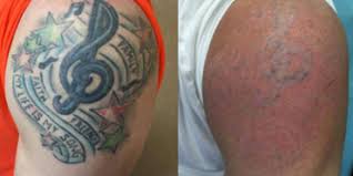 Laser Tattoo Removal Prices Results Benefits Risks Nexus Clinic Kuala Lumpur Malaysia