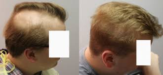 High doses of radiation may cause permanent damage to the hair follicles, causing permanent hair loss. Radiation Hair Loss Archives Fallon Hair Restoration