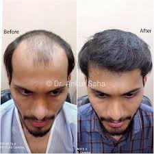 Young n Handsome' This dashing young man couldn't be more happier to get  back his amazing hair with our Best in class Hair Transplant and says he is  glad he chose the
