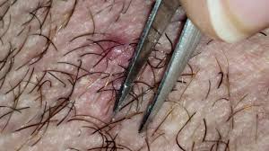 What do ingrown hairs look like? Infected Ingrown Hairs On A Man S Neck Satisfying Youtube
